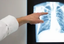 Kaduna records rise in TB case detection